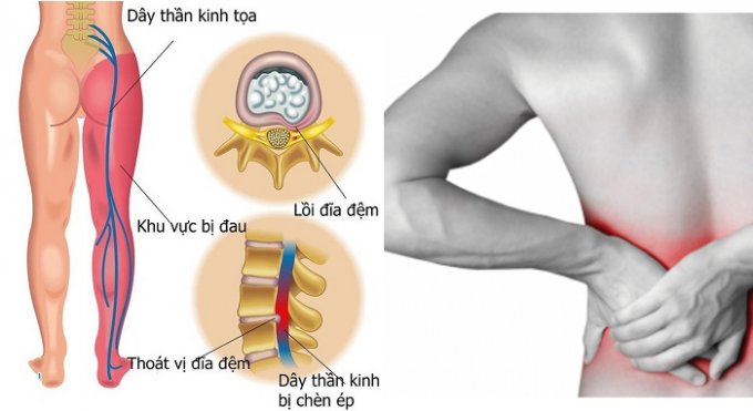 Thoát vị đĩa đệm phổ biến tại Việt Nam là nguyên nhân gây tê bì chân tay