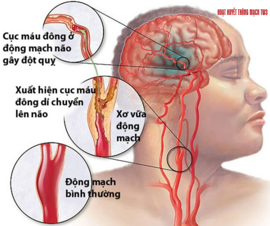 Cục máu đông là nguyên nhân chính gây tắc nghẽn mạch máu não